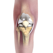 Patient Specific Knee Replacement