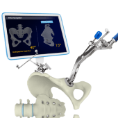 Computer Navigated Total Hip Replacement