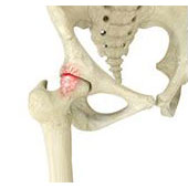 Femoroacetabular Impingement