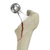 Femur Fracture