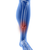 Fractures of the Tibia