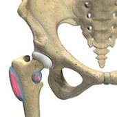 Hip Bursitis