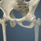 Hip Fracture Surgery