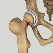 Hip Injury