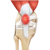 Kneecap Bursitis