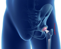 Minimally Invasive Total Hip Replacement