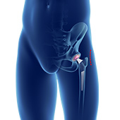 Minimally Invasive Total Hip Replacement