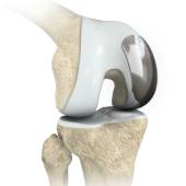 Unicompartmental/Partial Knee Replacement