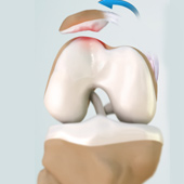 Patellar Dislocation/Patellofemoral Dislocation