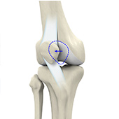 Patellar Instability