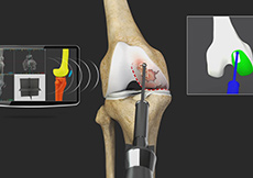 Robotic Hip Replacement