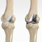 Total Knee Replacement