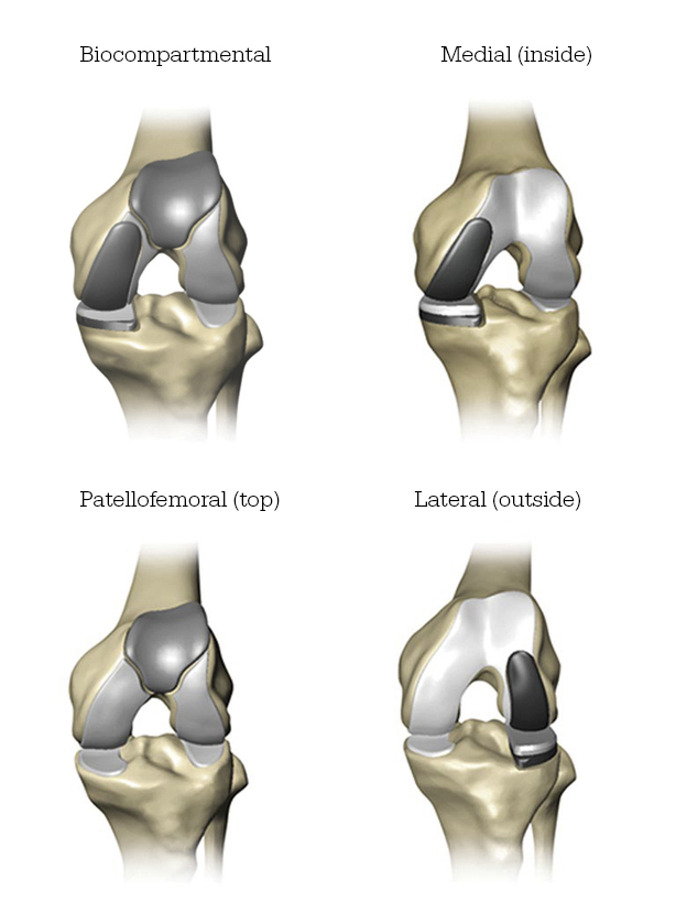 Mako Robotic-Arm Assisted partial knee replacement